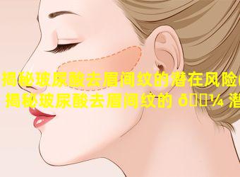 揭秘玻尿酸去眉间纹的潜在风险(揭秘玻尿酸去眉间纹的 🌼 潜在风险有哪些)